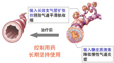 哮喘氣道炎癥中的抗炎新機(jī)制