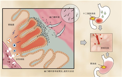 質子泵抑制劑